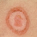 How Athletes Can Avoid Ringworm