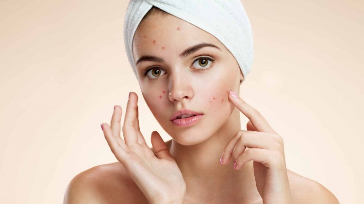 How To Treat and Cure Acne