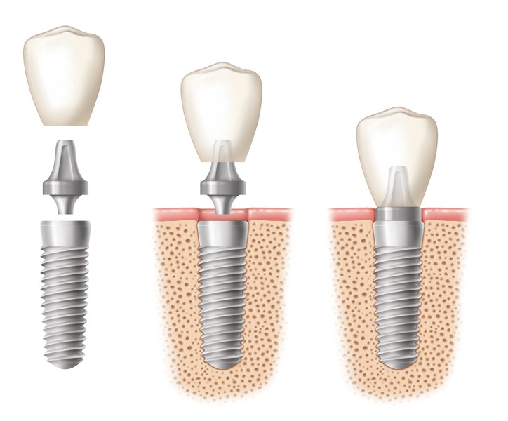 What To Expect from Dental Implant Surgery