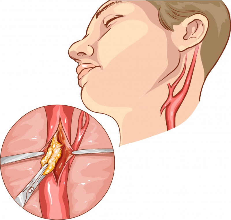 Everything About Carotid Endarterectomy